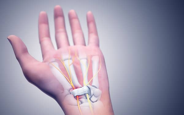 sinir-sikismasi-karpal-tunel-sendromu-2